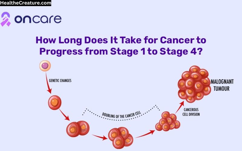 How Long Does It Take for Cancer to Progress from Stage 1 to Stage 4?